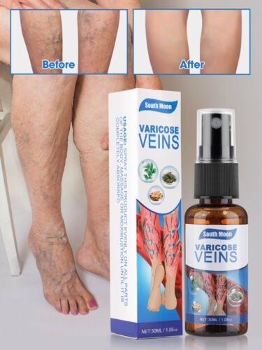 Varicose Veins Relief Spray (Orignal)